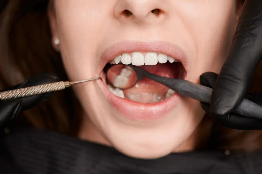 Dentist performing scaling and root planing to remove plaque and tartar during a deep cleaning procedure.
