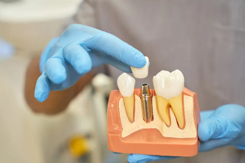Dental implant model showing a titanium implant in the jawbone with a replacement crown positioned above it.