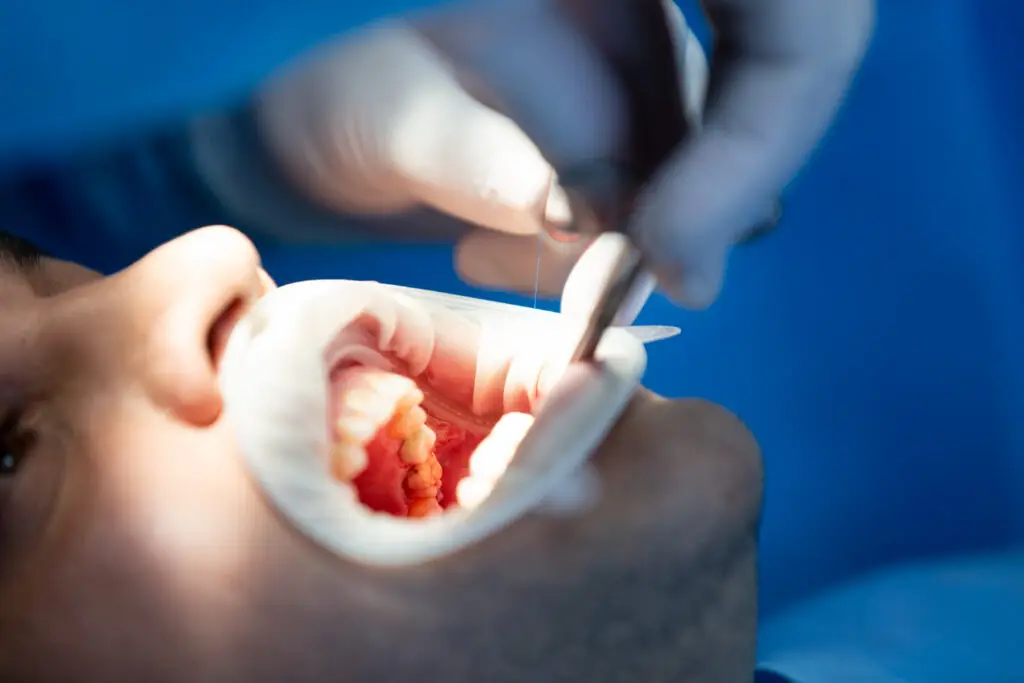 Dentist performing a tooth extraction procedure on a patient in a dental clinic.