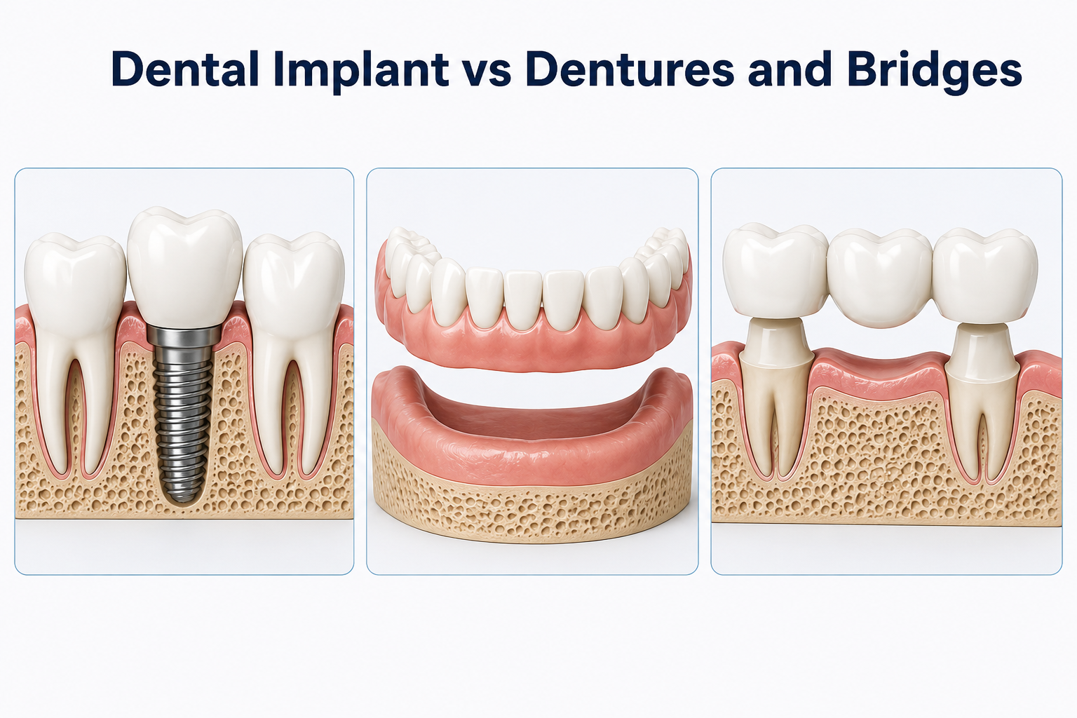 Dental implants, dentures, and bridges compared as tooth replacement options for missing teeth.